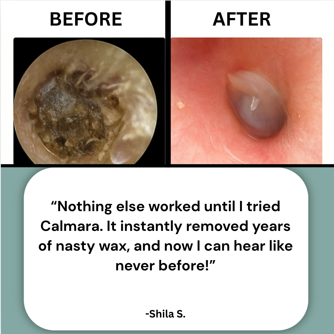 Calmara™ Ear Wax Remover