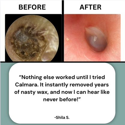Calmara™ Ear Wax Remover